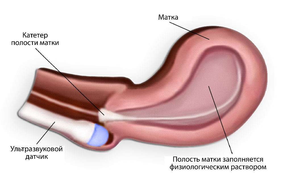 Рисунок 1. Заполнение полости матки физиологическим раствором через катетер