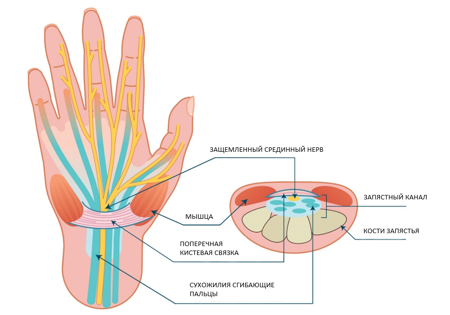 Рисунок 1. Запястный канал и защемленный срединный нерв.