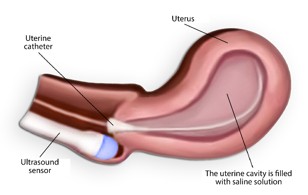 Figure 1. Filling the uterine cavity with saline through the catheter