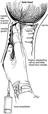 Other techniques for obstetric pain management: Caudal, paracervical, and pudendal  blocks - ScienceDirect