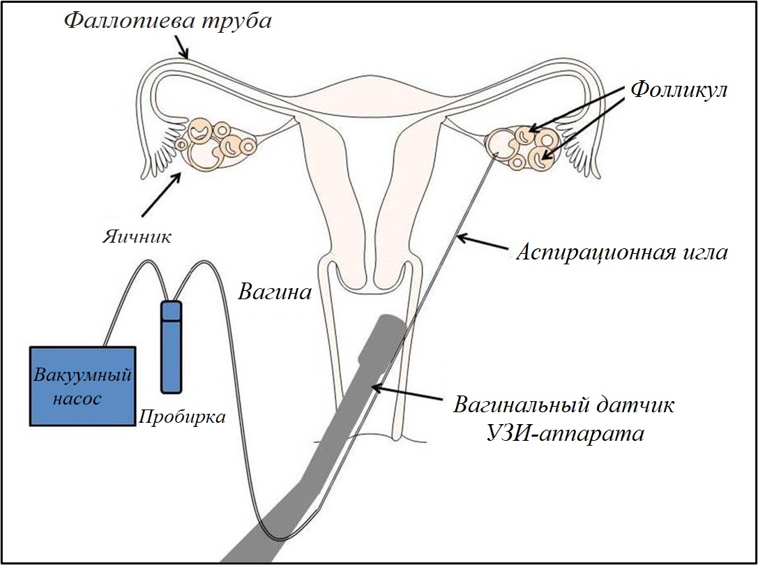 Diagram of a uterus with a needle attached to it</p>
<p>Description automatically generated